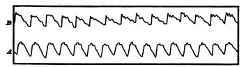 Fig. 23. Sphymographic pulse-tracing. _A_, during intellectual repose; _B_, during intellectual activity. (Mosso.).